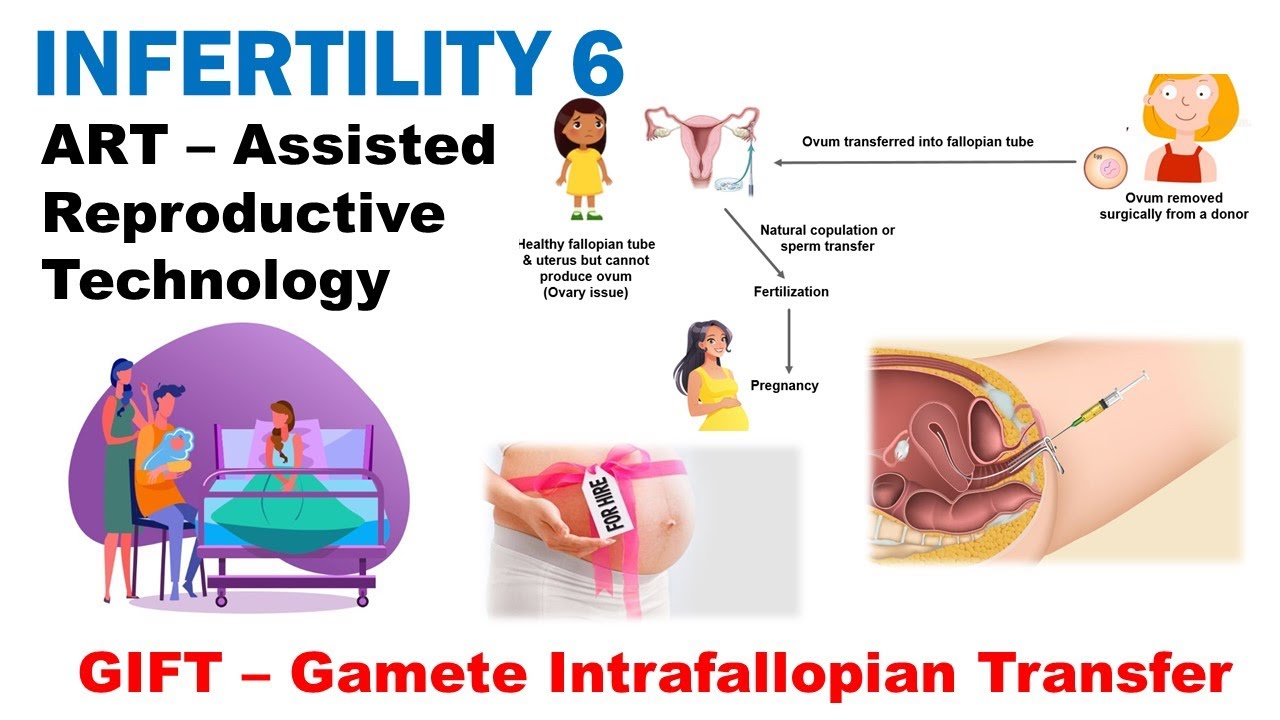 Infertility 6 | Assisted Reproductive Technology (ART) | GIFT | IUI | AIT | Dr Ghanshyam Jangid