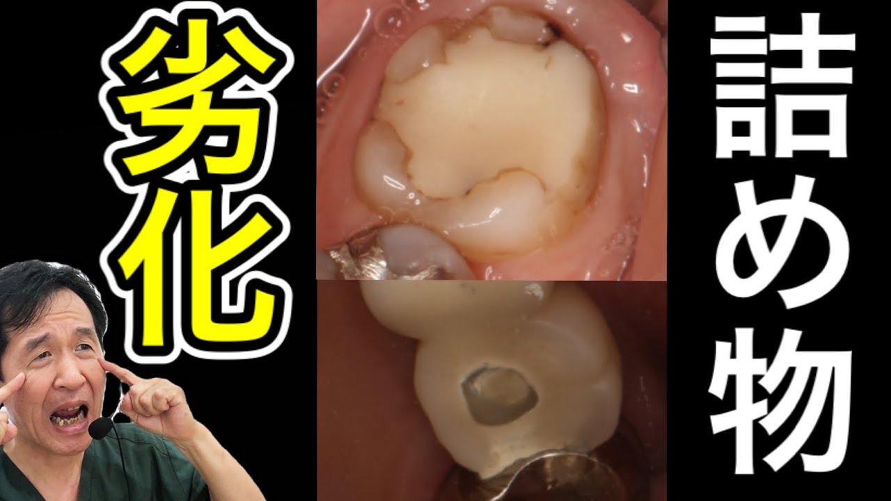 詰め物する前に注意が必要です‼【レジン・セラミック・銀歯・金歯】