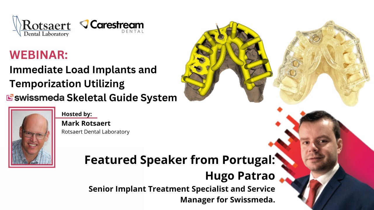 Immediate Loading Implants with a Model-less Approach for Full Control of the Final Outcome