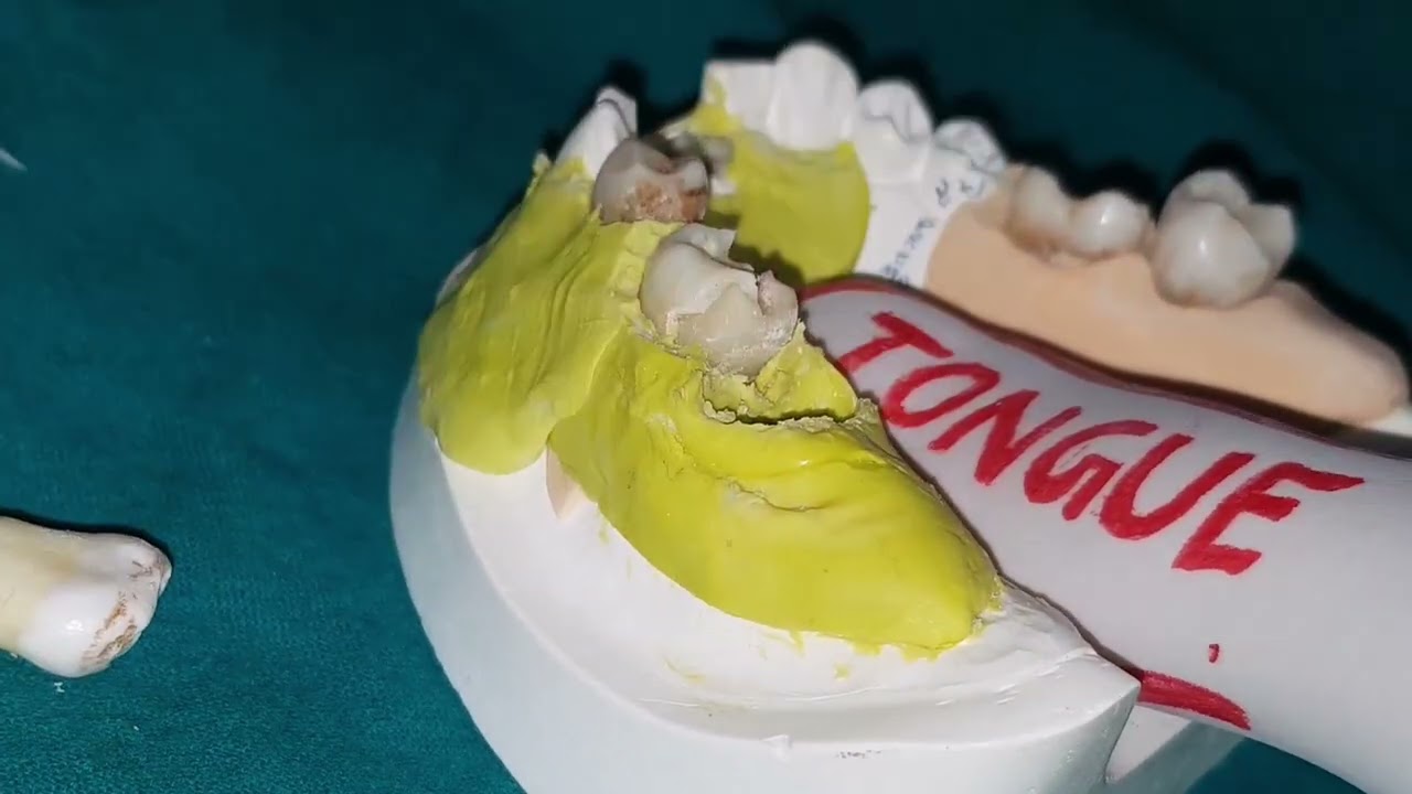 how to use elevators in dentistry to extract the tooth - Dr Nishit k shah