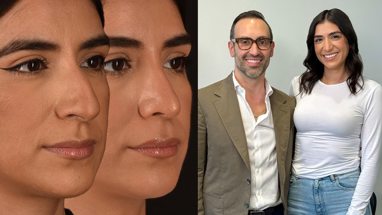 Patient Case Highlight: Yocelin's One Year Rhinoplasty Journey