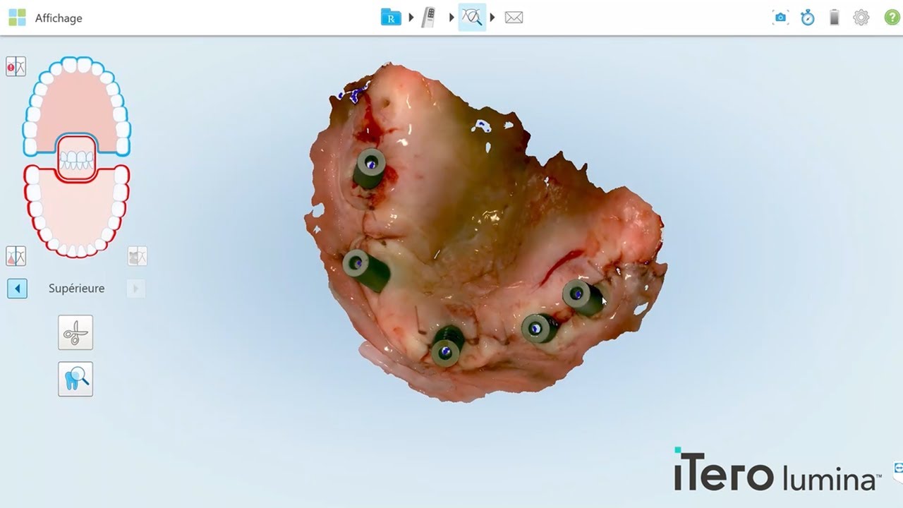 All-on-5 restorative scanning done in under 60 seconds | iTero Lumina™ intraoral scanner