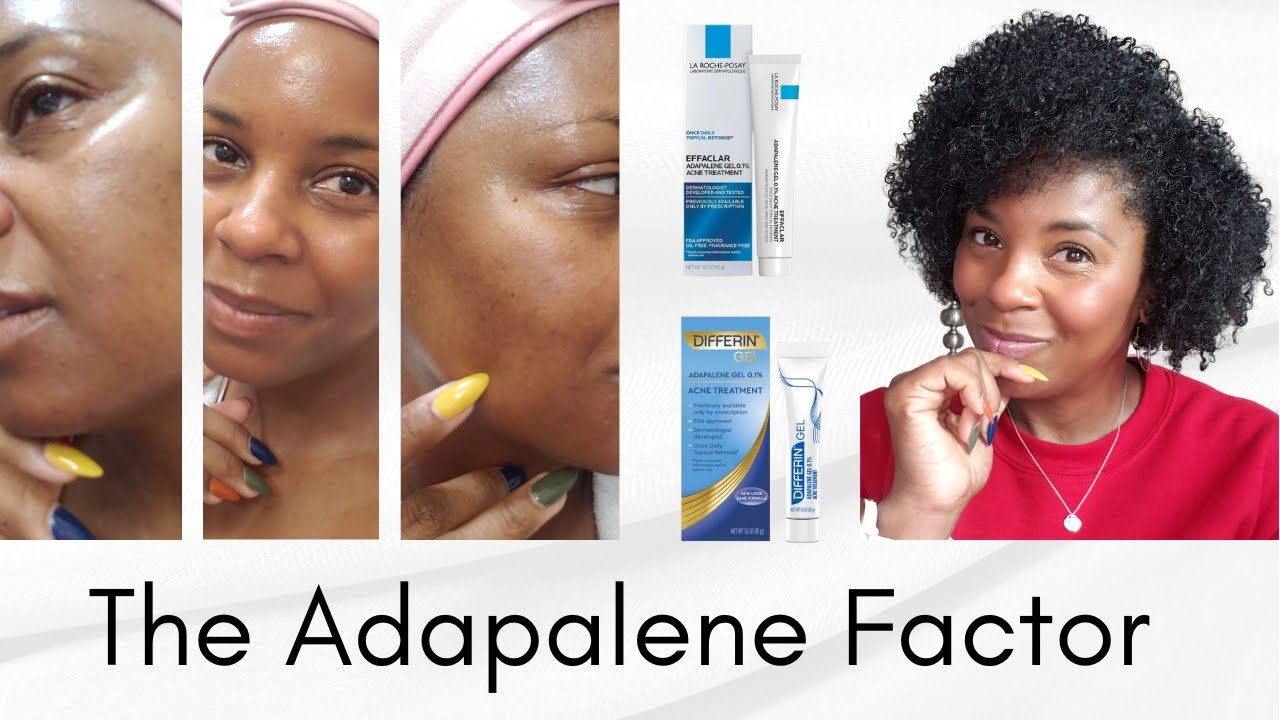 Adapalene: My Secret Weapon to Beautiful Skin (At Any Age)