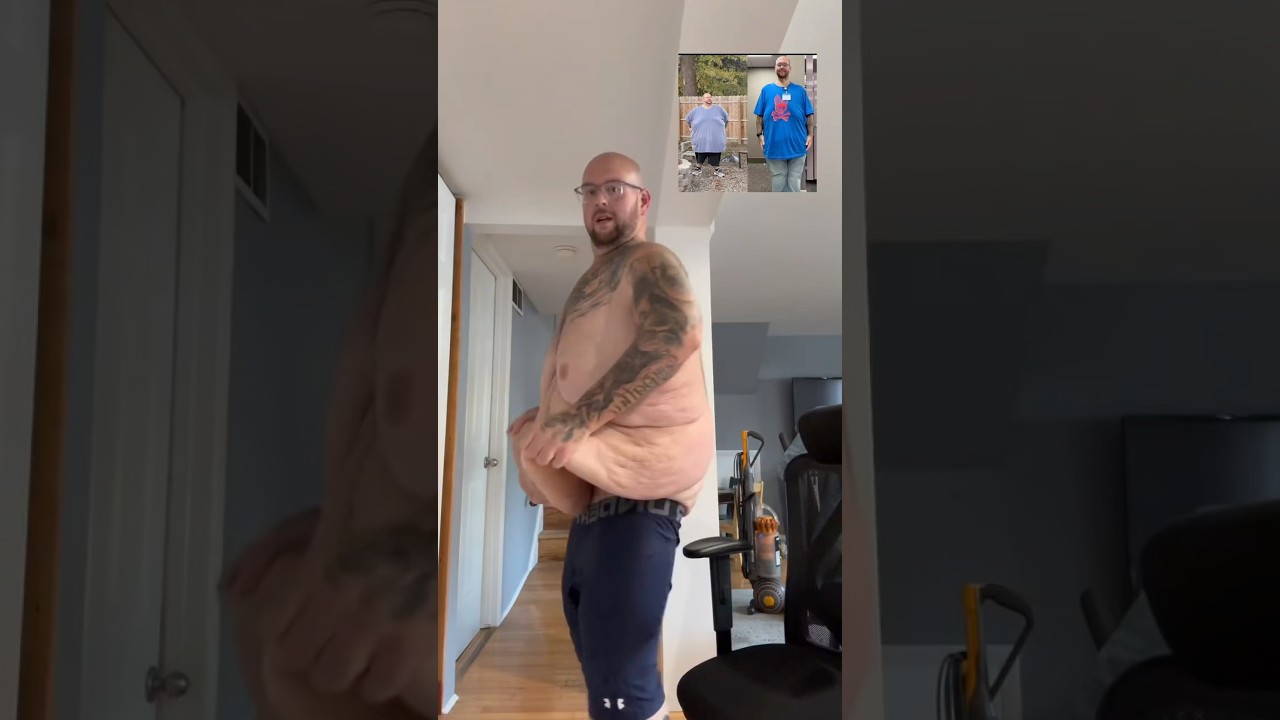 The Truth About Losing Weight: His Loose Skin Story