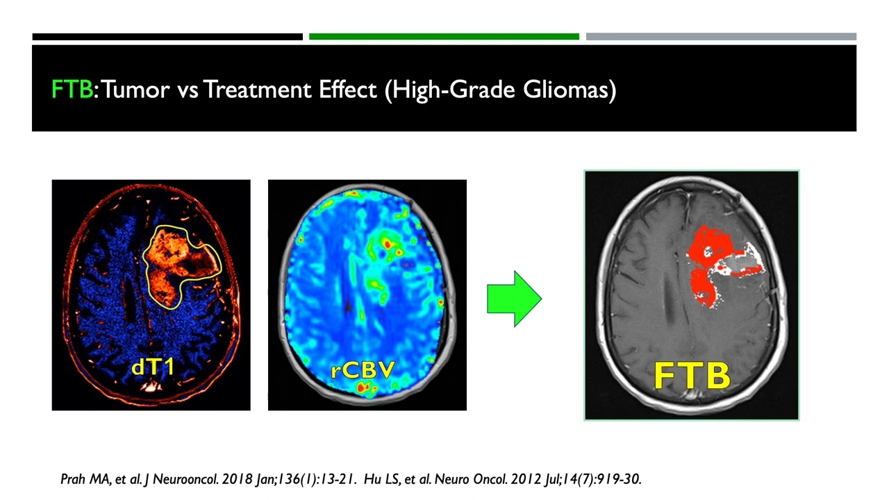 Advanced MRI Measurements of Brain Tumors