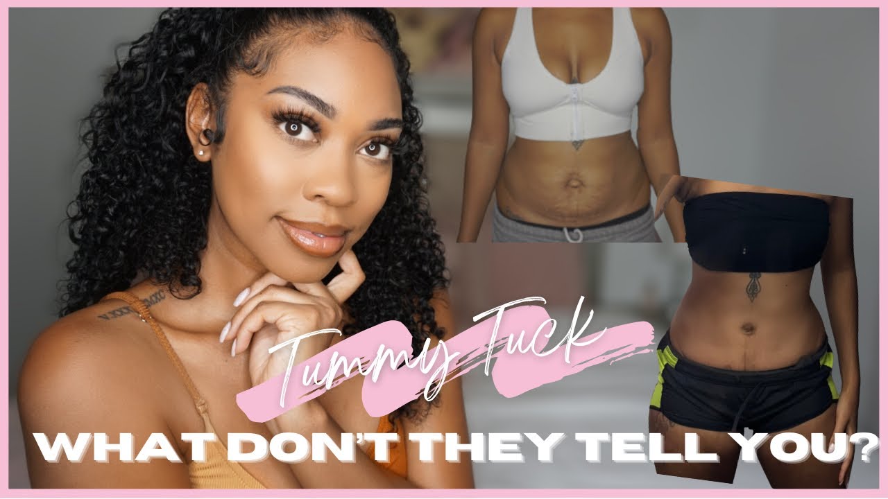 Tummy Tuck 4 month update  | What you need to know