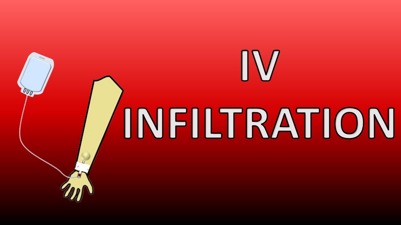 IV Infiltration (Leakage through insertion site) | Signs & Symptoms | Causes | Management