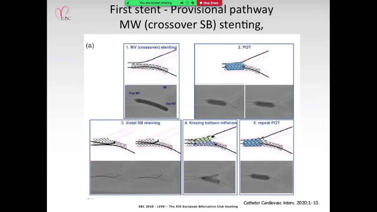 Why POT is so important in Left Main PCI - Dr Jens Flensted Lassen