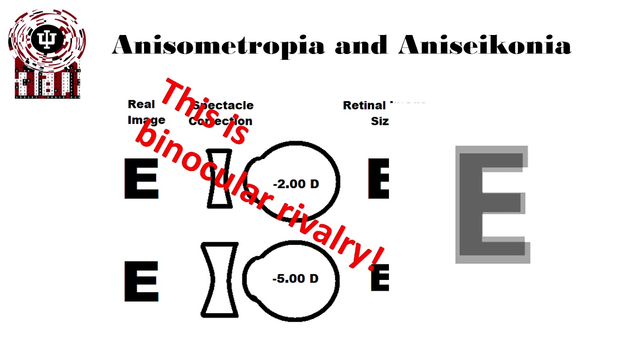 Anisometropia Definitions