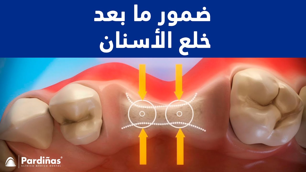 ضمور ما بعد خلع الأسنان ©
