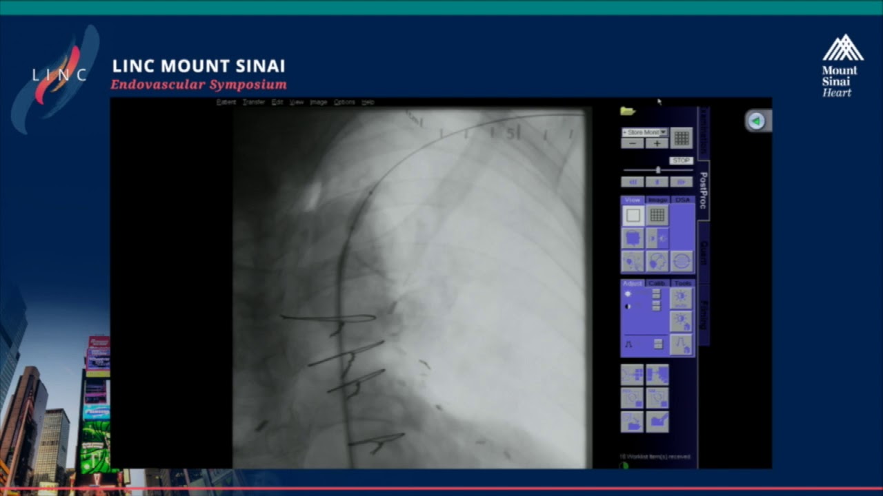 Live Case Presentation #6 SYMPTOMATIC SUBCLAVIAN STENOSIS