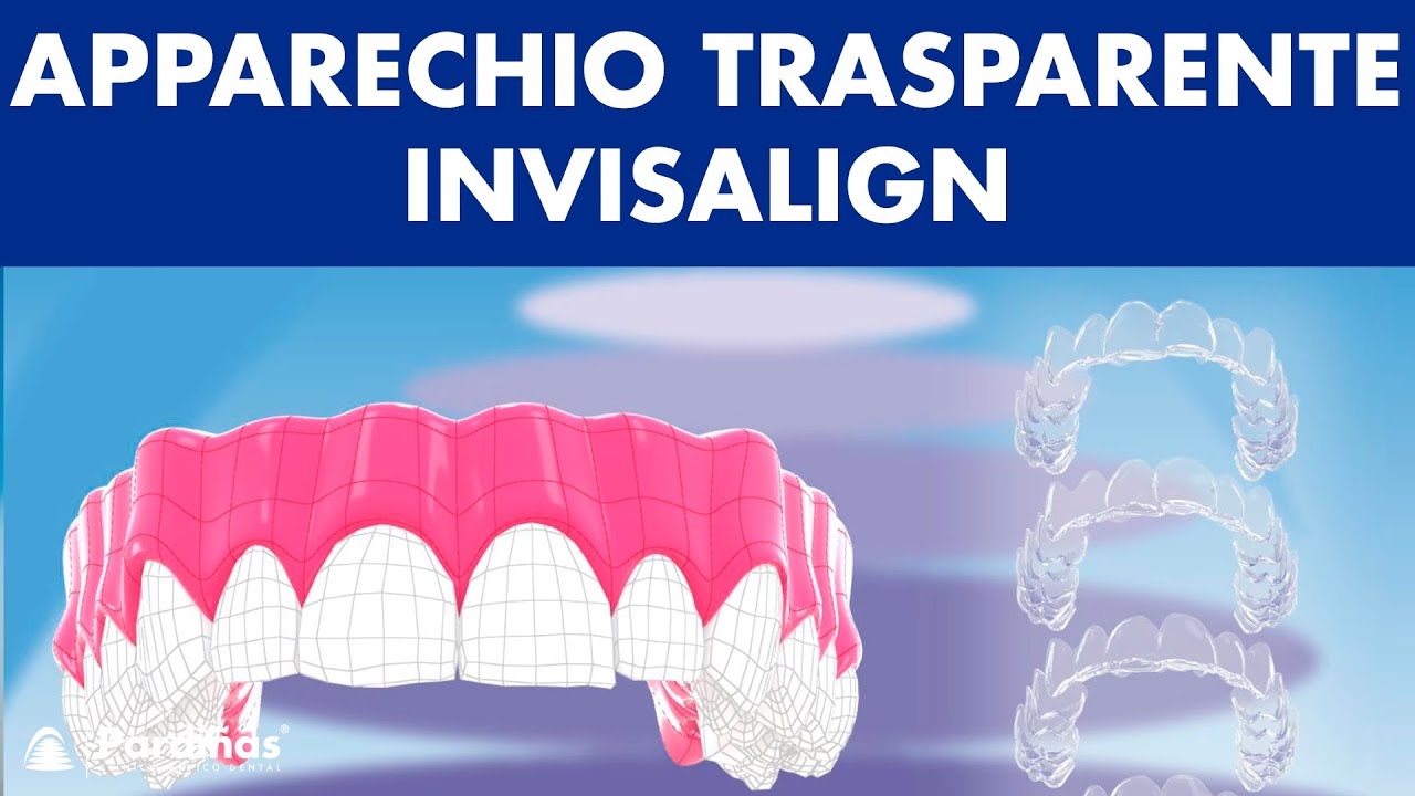 APPARECHIO trasparente con allineatori dentali invisibile - INVISALIGN &copy;