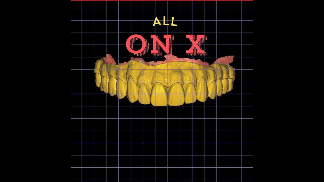 All on X #dailywork #design #naildesign #dental #dentaldesign #exocadexpert #allonx @exocadvideos