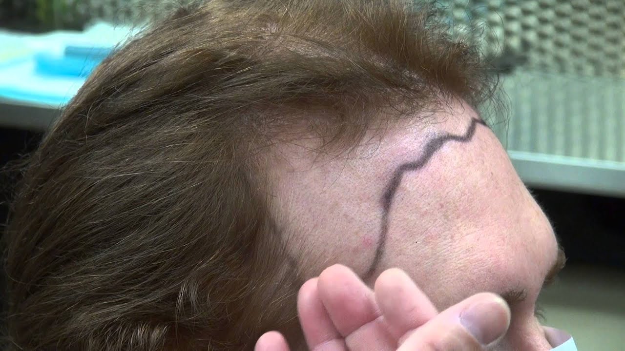 Transwoman Transexual Hair Restoration Surgery Hairline Transgender Dr. Diep www.mhtaclinic.com