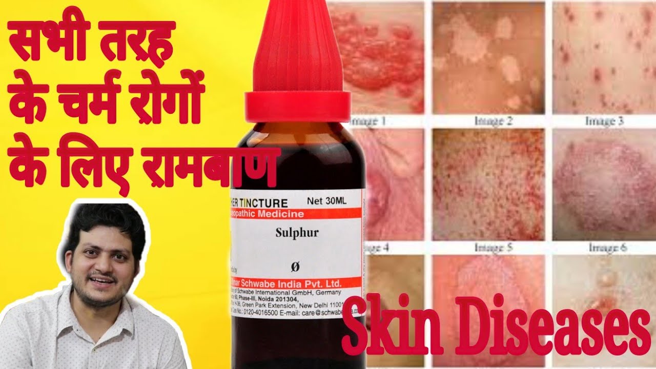 Sulphur Mother Tincture ko kaun kaun si skin disease (चर्म रोग) में use Karen aur kaise use Karen ?
