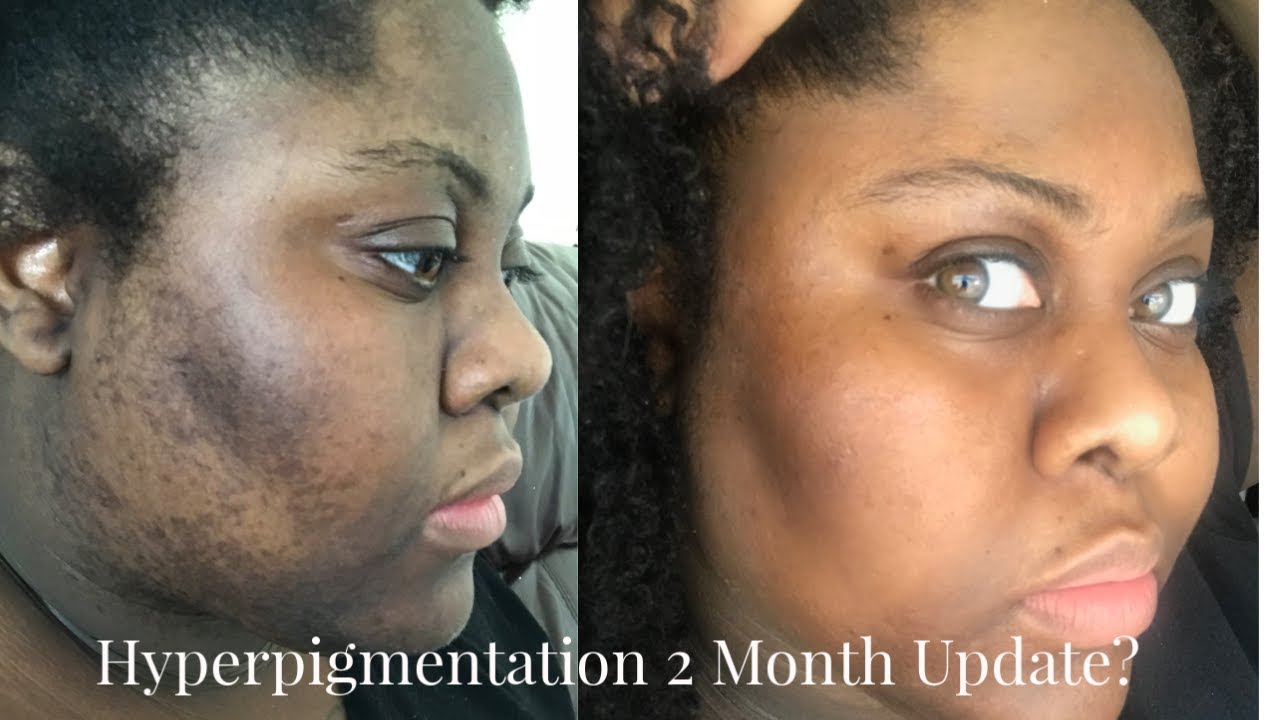 5 DAY TURMERIC FACE MASK // FOLLOW UP