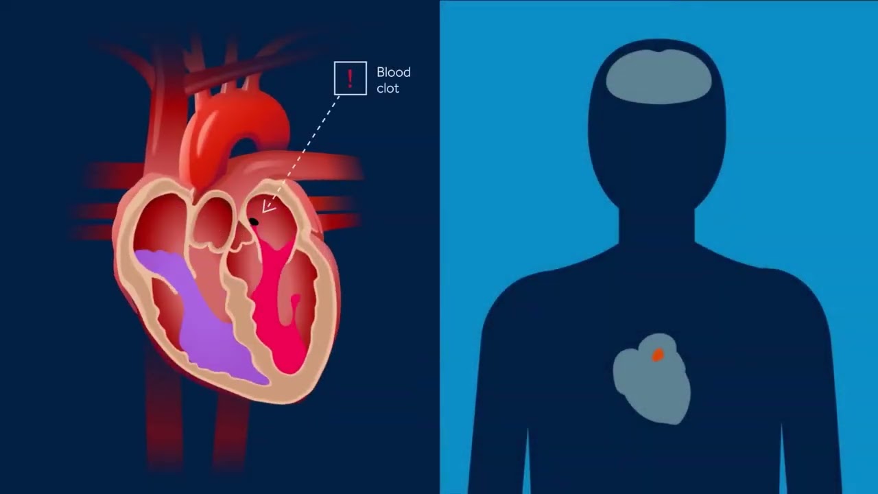 Medtronic|  Gunasekaran's  Cryoablation Journey