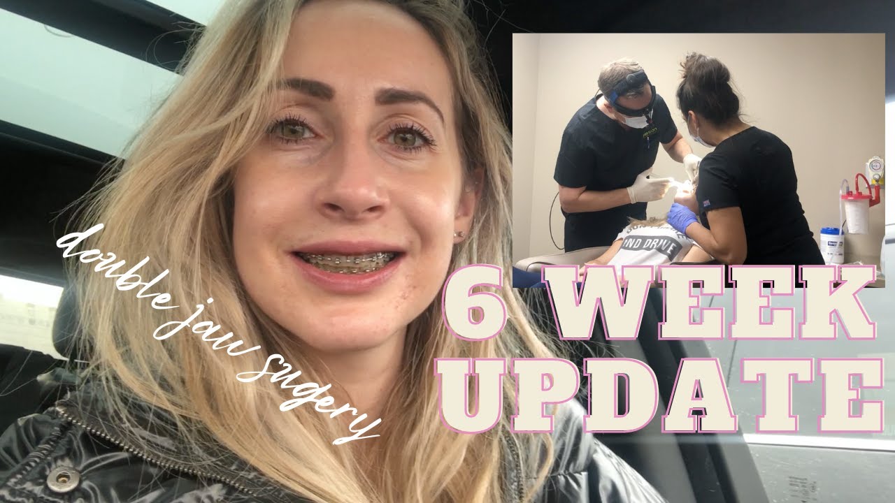 Double jaw surgery 6 week update