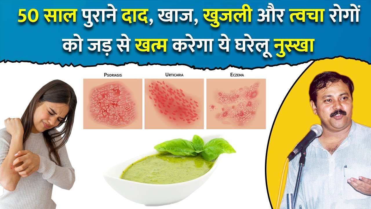 Rajiv Dixit - 50 साल पुराने दाद, खाज, खुजली और त्वचा रोगों के लिए घरेलू नुस्खा
