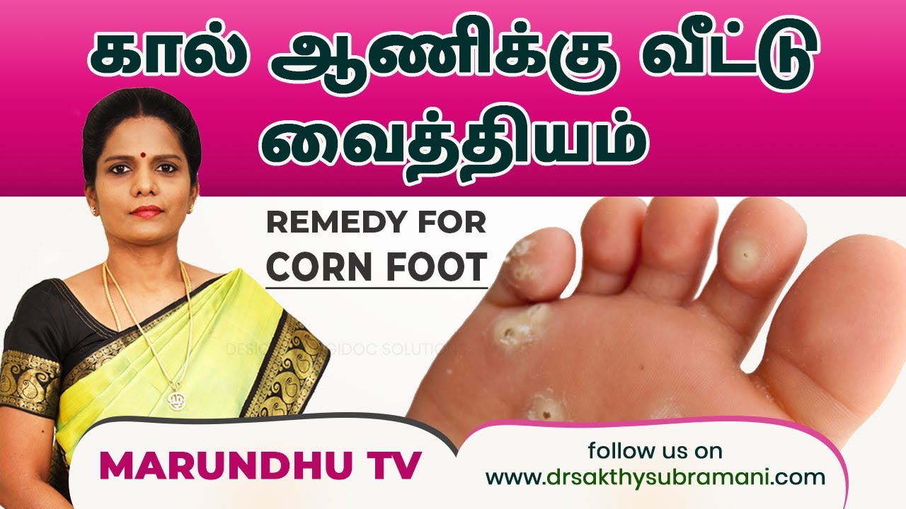 கால் ஆணிக்கு வீட்டு வைத்தியம் /Home Remedy for corn foot.