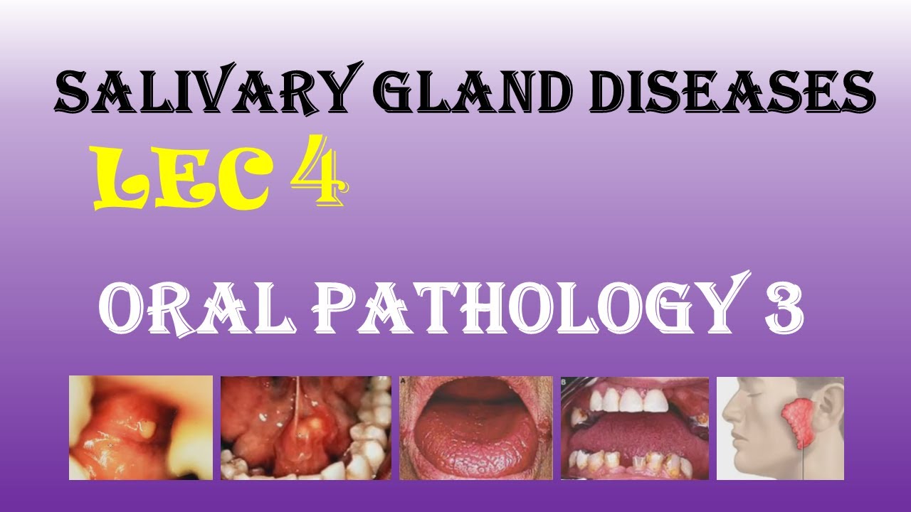 Oral Pathology 3 - LEC 4 -  Salivary gland diseases