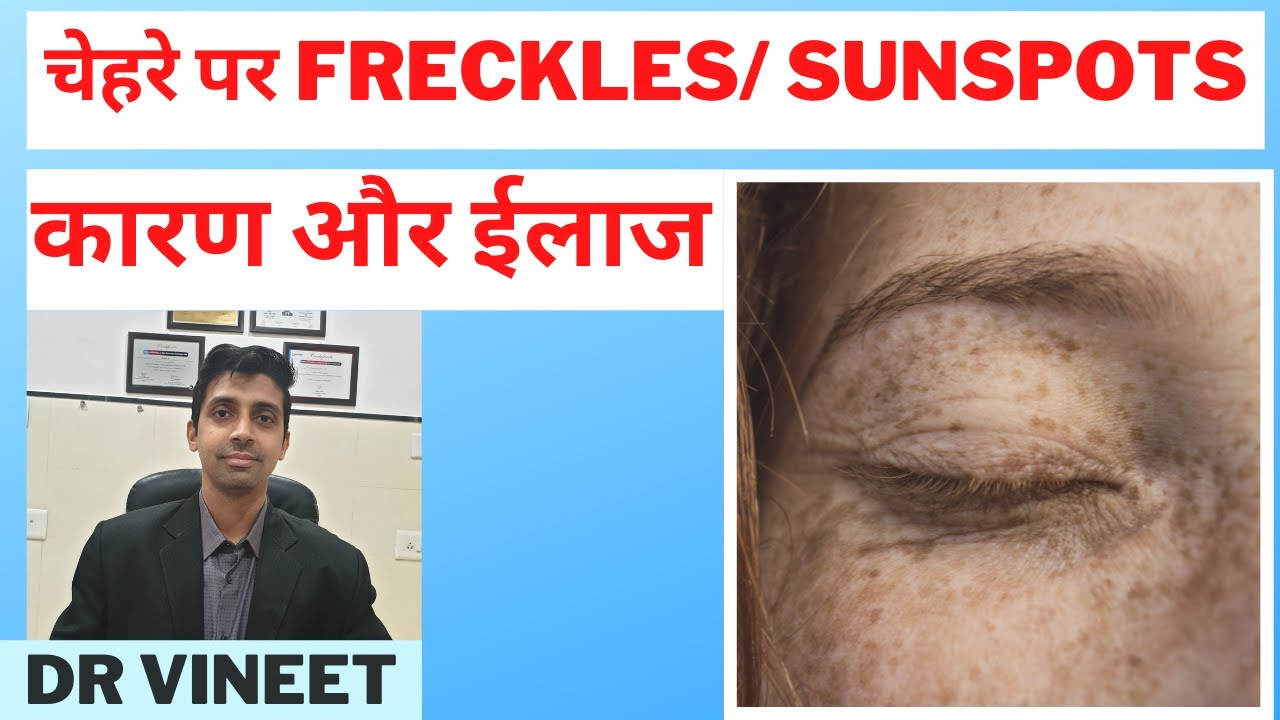 Freckles or Sunspots- Causes & Treatment | चेहरे पर तिल/दाग धब्बे से कैसे पाए छुटकारा | Dr Vineet