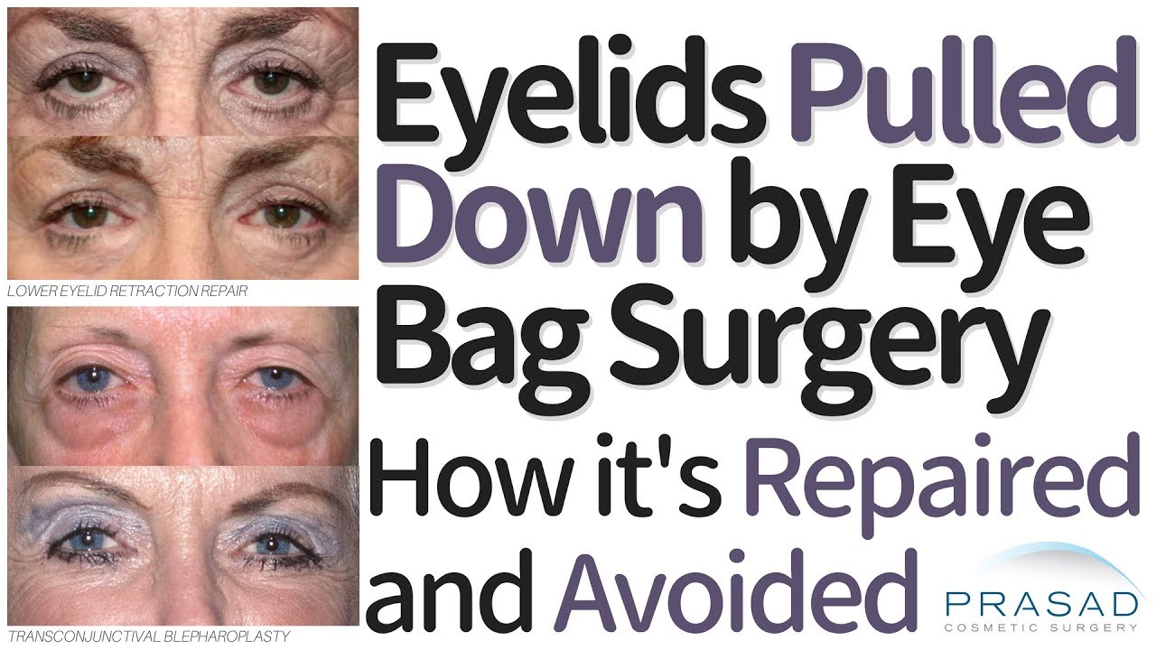What to do if Your Lower Eyelids Were Pulled Down After Eye Bag Surgery, and How it can be Avoided