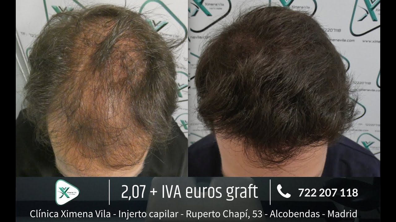 Trasplante capilar FUE - Hair transplant - Dra. Ximena Vila - 6202 Grafts