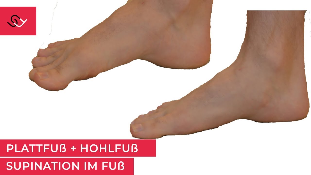 Plattfuß sofort aufrichten - Gluteus medius als Schlüssel - Mach diese 3 Übungen