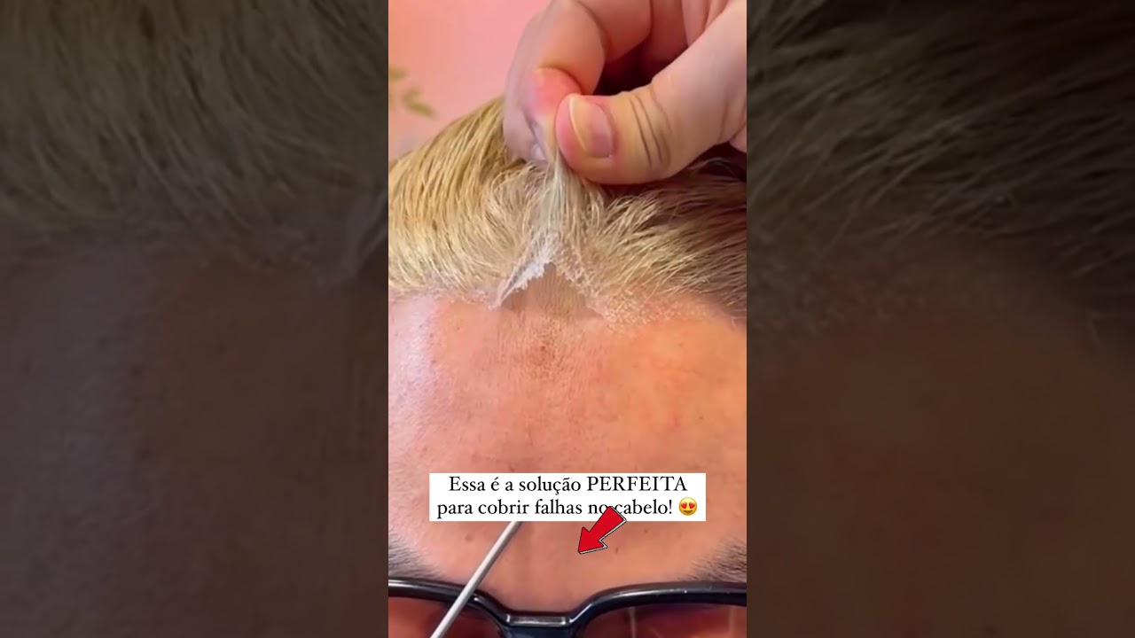 CHEGA DE CALVICE ! #shopee #achadinhos #calvicie #calviciefeminina #calvicemasculina #cabelo #careca