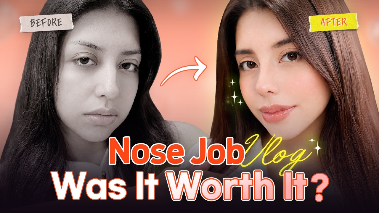 I Can't Believe It's My Nose! 🥺 From Hooked & Droopy to Elegant: My Rhinoplasty Story 🦢