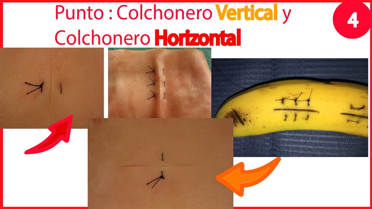 Técnica de Sutura : Colchonero Vertical y Colchonero Horizontal  / Practica en Plátano / Parte 4