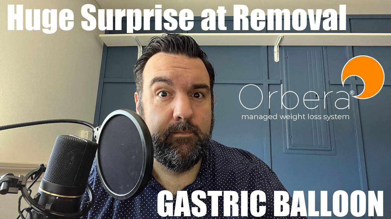 ORBERA - My journey with the BALLOON Procedure - Removal and Huge Surprise