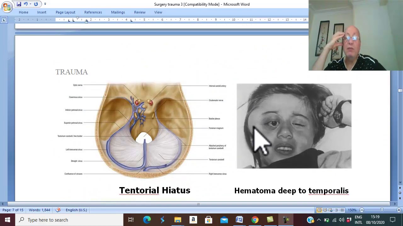 Trauma in Arabic 15 (Epidural haemorrhage , part 1) , by Dr. Wahdan