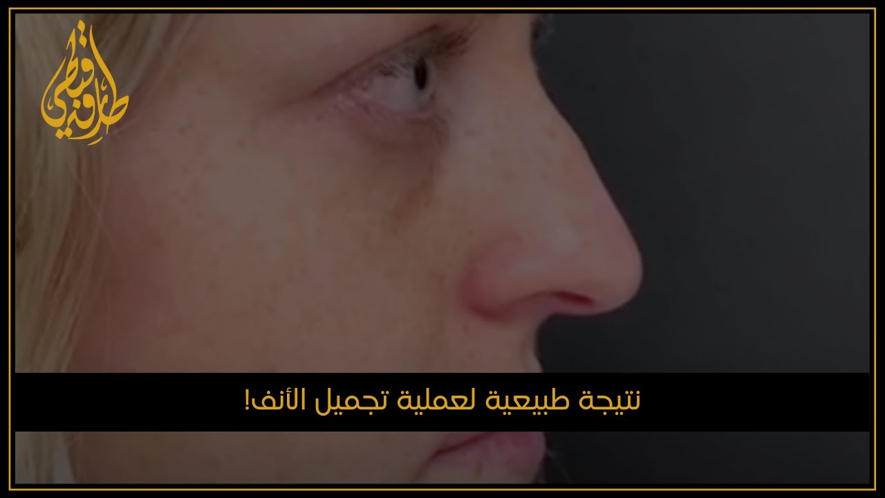 مركز الدكتور طارق قبطي للتجميل | عملية تجميل الأنف حسب طلب المريض