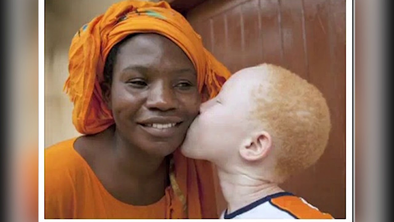 INTERNATIONAL ALBINISM AWARENESS DAY