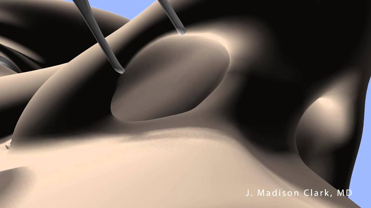 Nasal Butterfly Graft Surgery