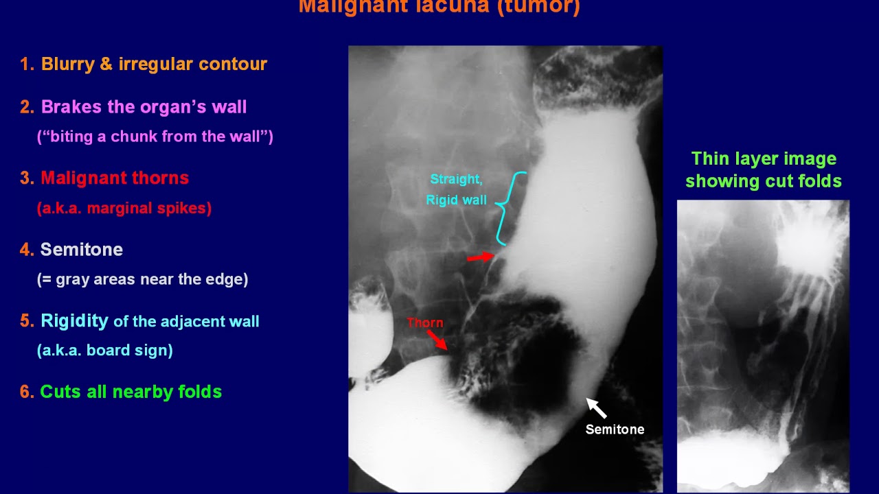 Digestive tract fluoroscopy - Basic lesions