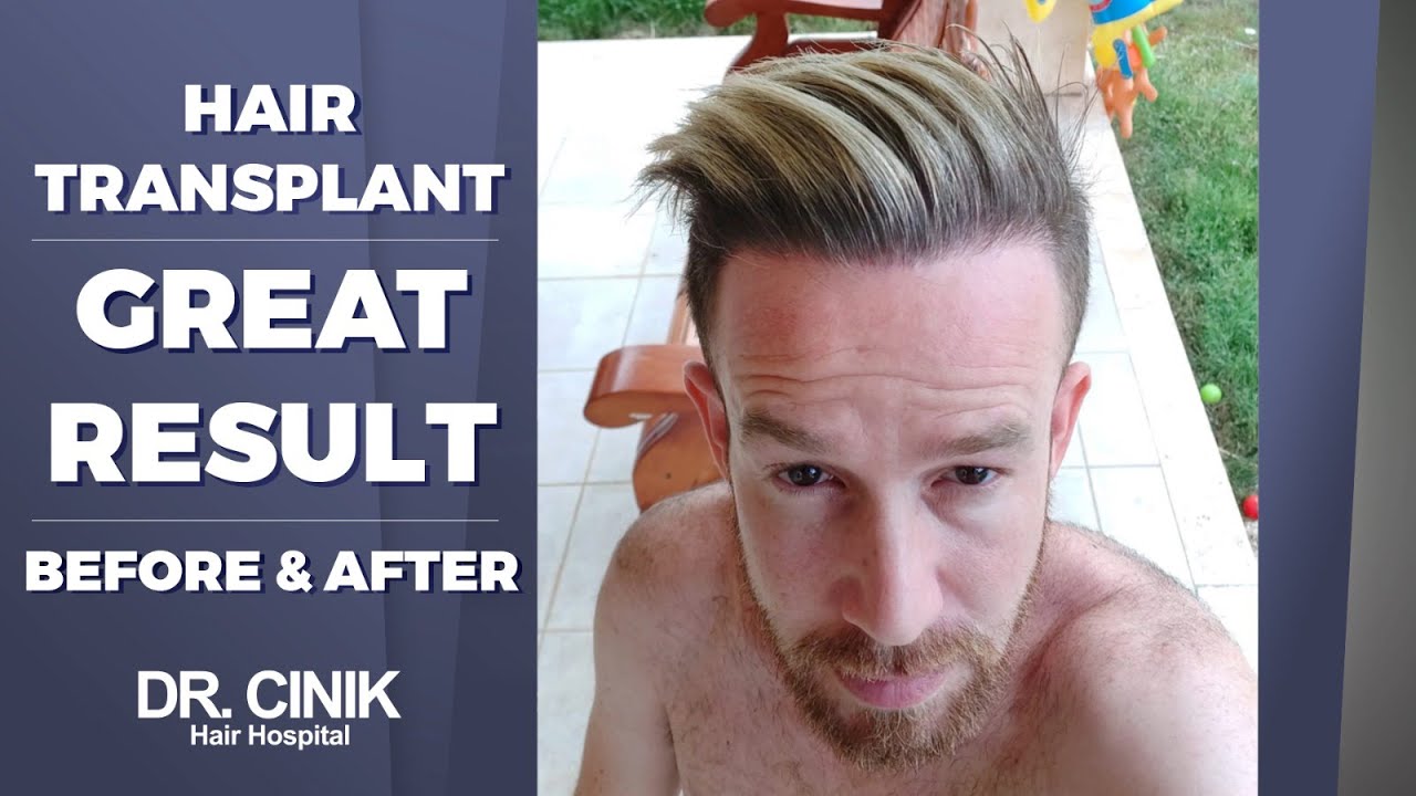 GREAT RESULT | Hair Transplant | Dr. Emrah Cinik
