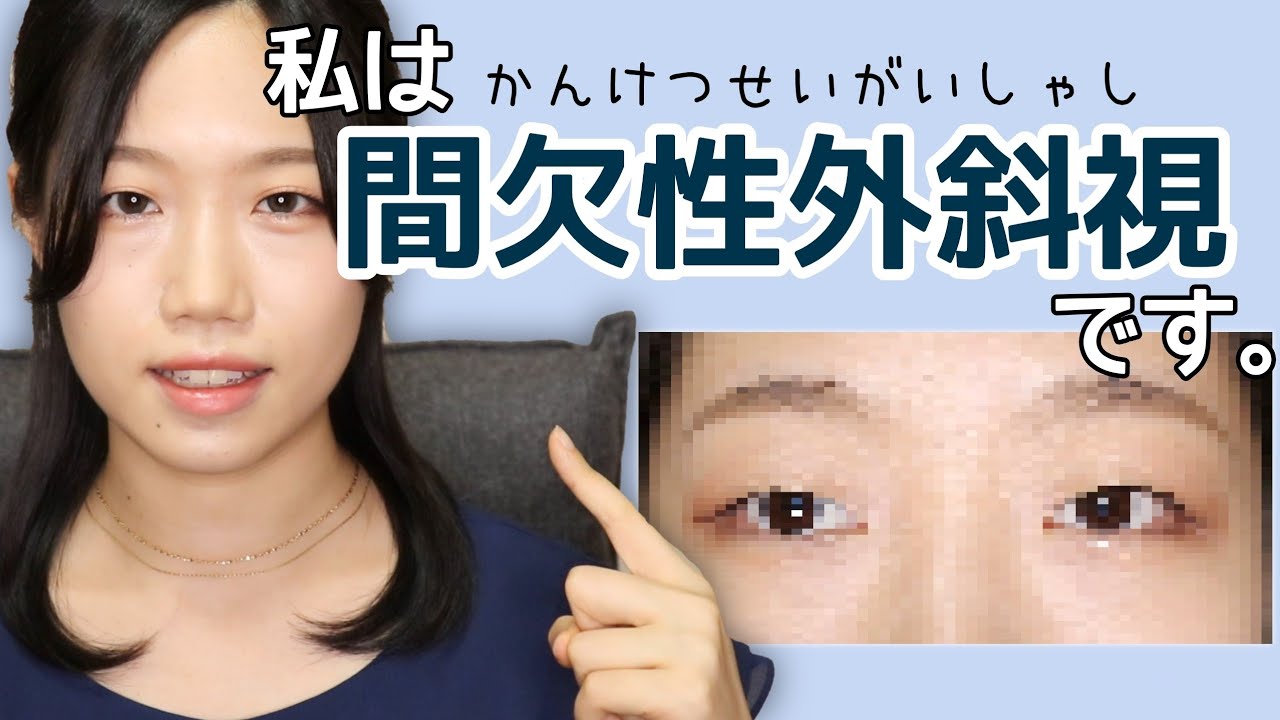 私は「間欠性外斜視」です/斜視って何？/実際の見え方/見た目の問題/今後について【おしゃべりおじこ番外編】
