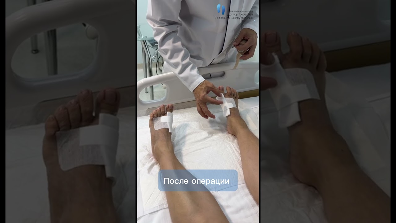 Лечение HALLUX VALGUS шишка на ногах #вальгус #плоскостопие #здоровье #здоровыйобразжизни #хирург