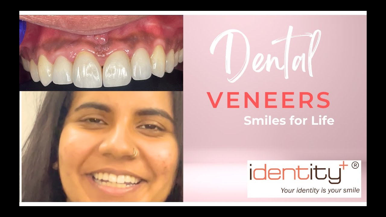 Ceramic Veneer Smile Makeover