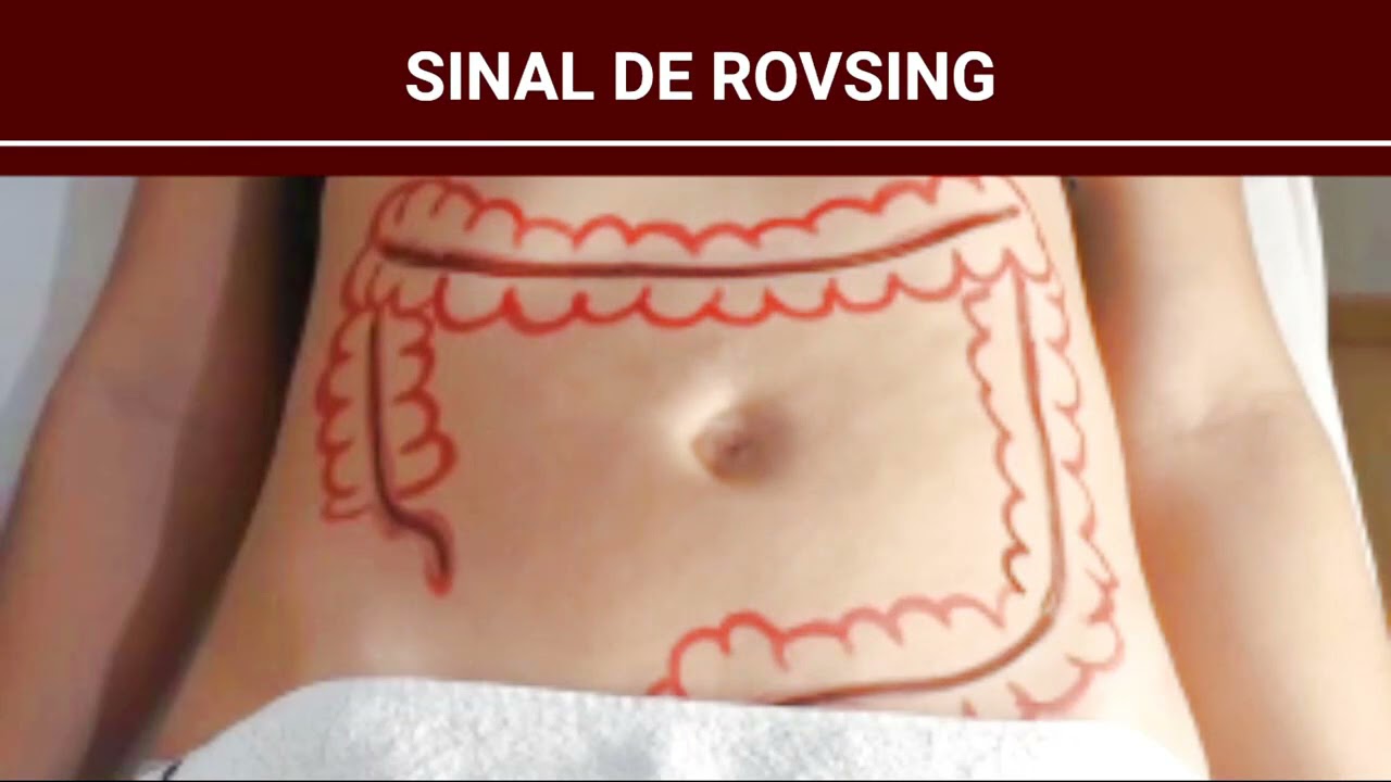 sinal de rovsing