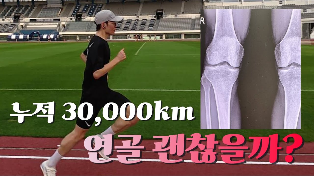 3만km 뛴 무릎 엑스레이를 본 의사의 첫마디