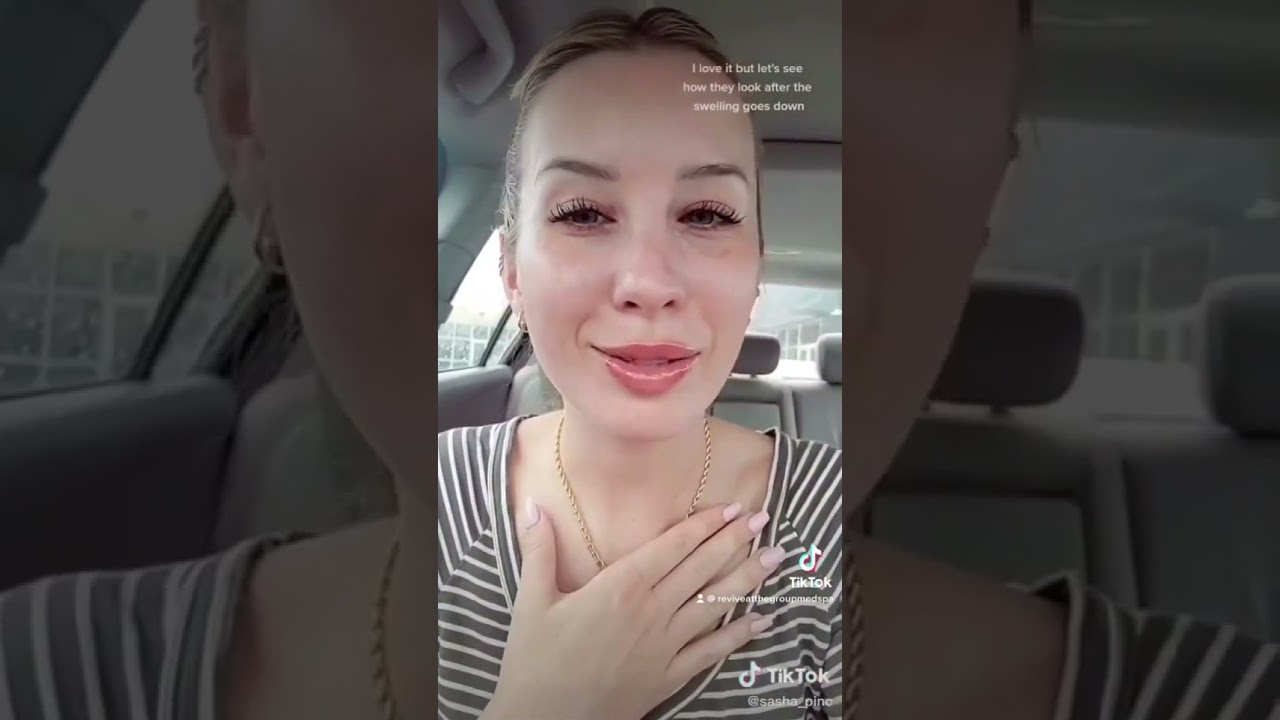1 Syringe Restylane Kysse Lip Filler