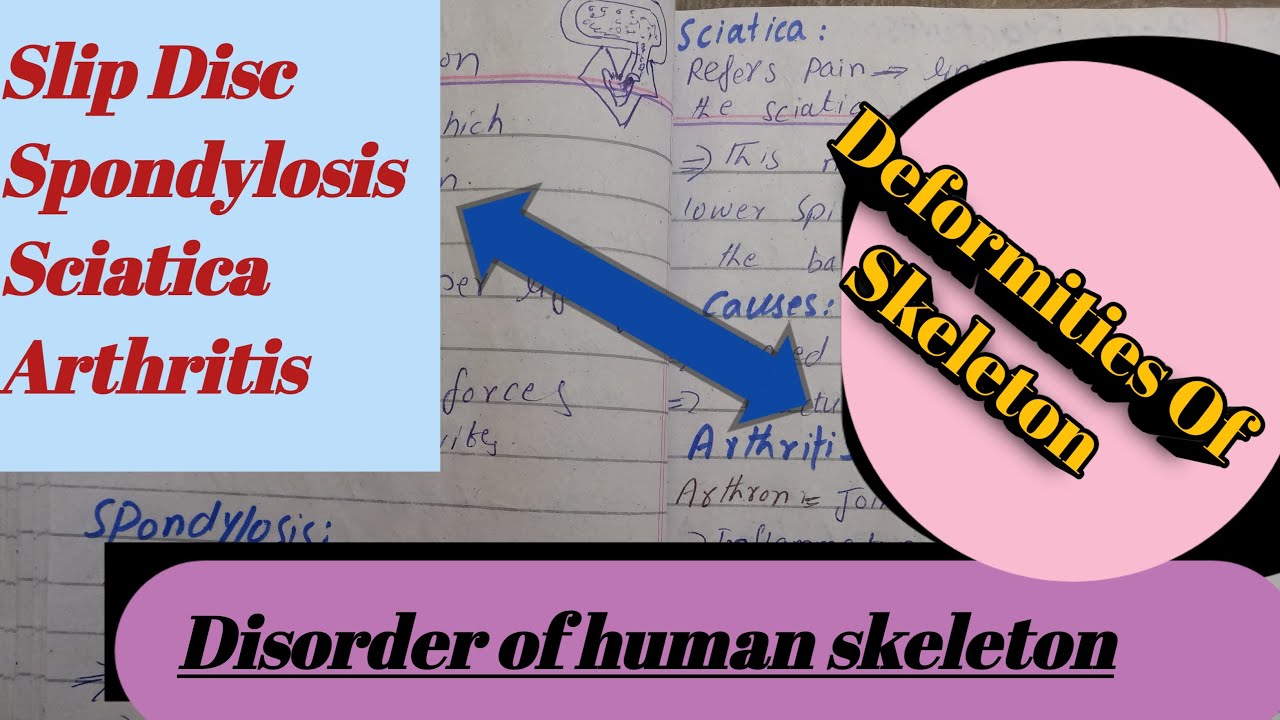 Deformities Of Skeleton|Disorders OF Skeleton |Slip Disc|Spondylosis|Sciatica|Arthritis|Bone Fractur