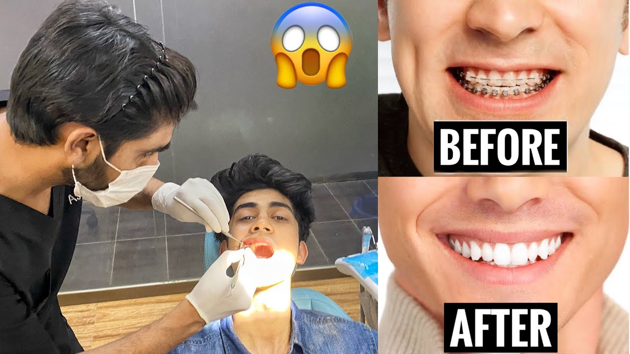 My BRACES experience!! (crazy transformation)