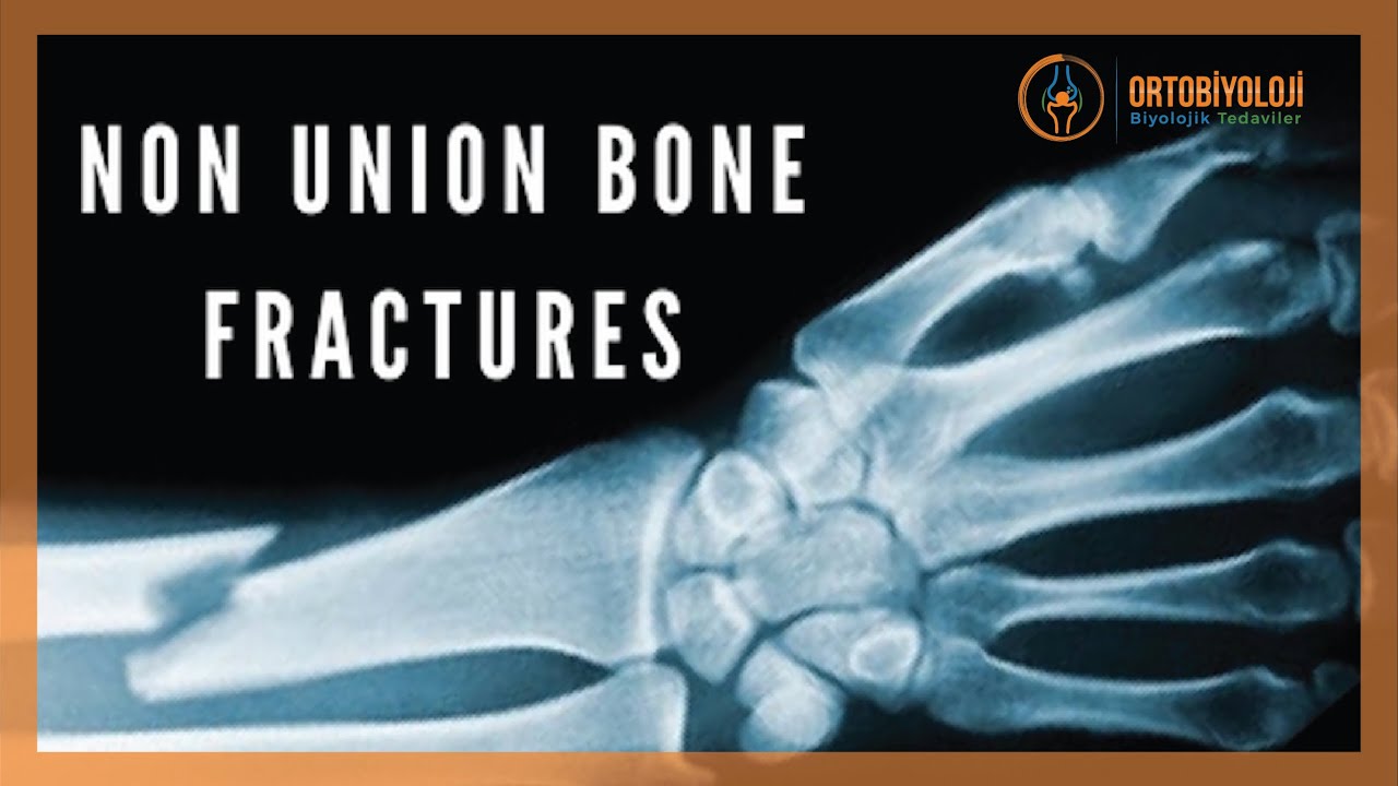 BONE NONUNIONS