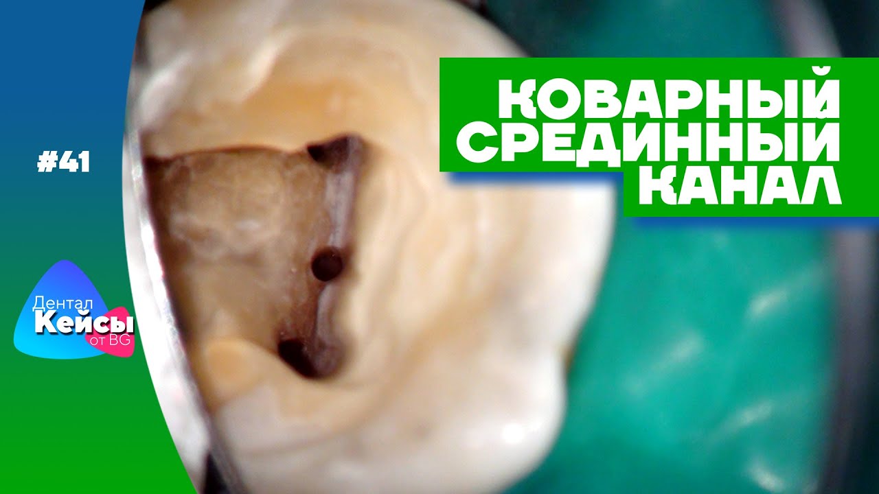 Коварный срединный канал | Дентал Кейсы от BG #41