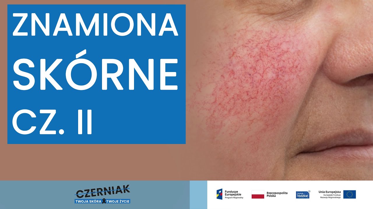 Znamiona sk&oacute;rne cz. II - Prof. dr hab. n. med. Agnieszka Żebrowska